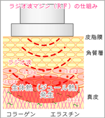 ラジオ波マシン(RF)の仕組み
