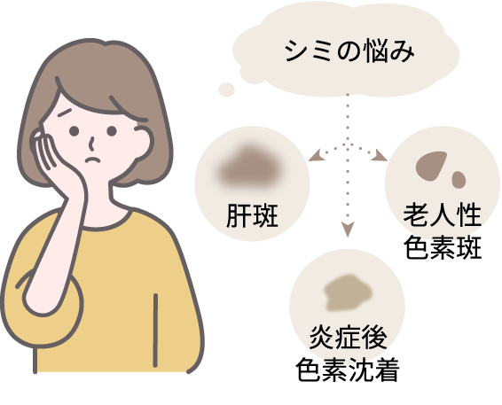シミの悩み