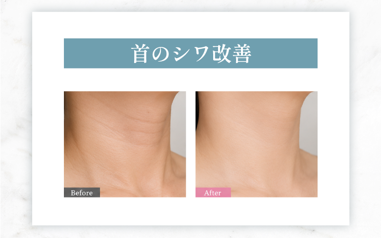 首のシワ改善