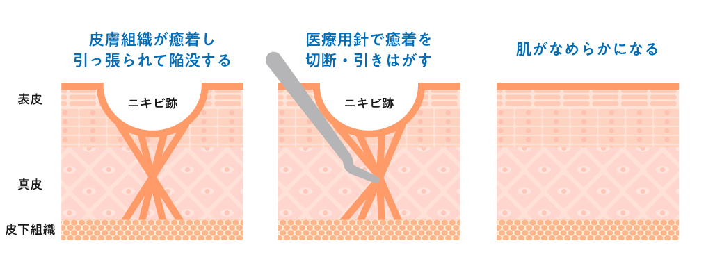 サブシジョンで期待できること