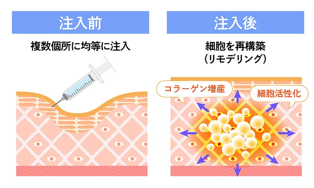 次世代ヒアルロン酸|スネコスとプロファイロを徹底比較 | 麻布十