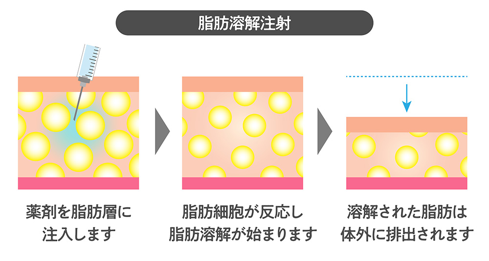 脂肪溶解注射