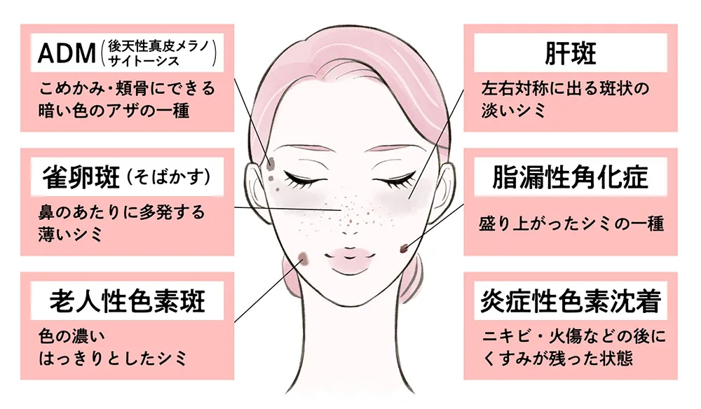 シミを消す方法は美容クリニックの治療がおすすめ。医師がシミの