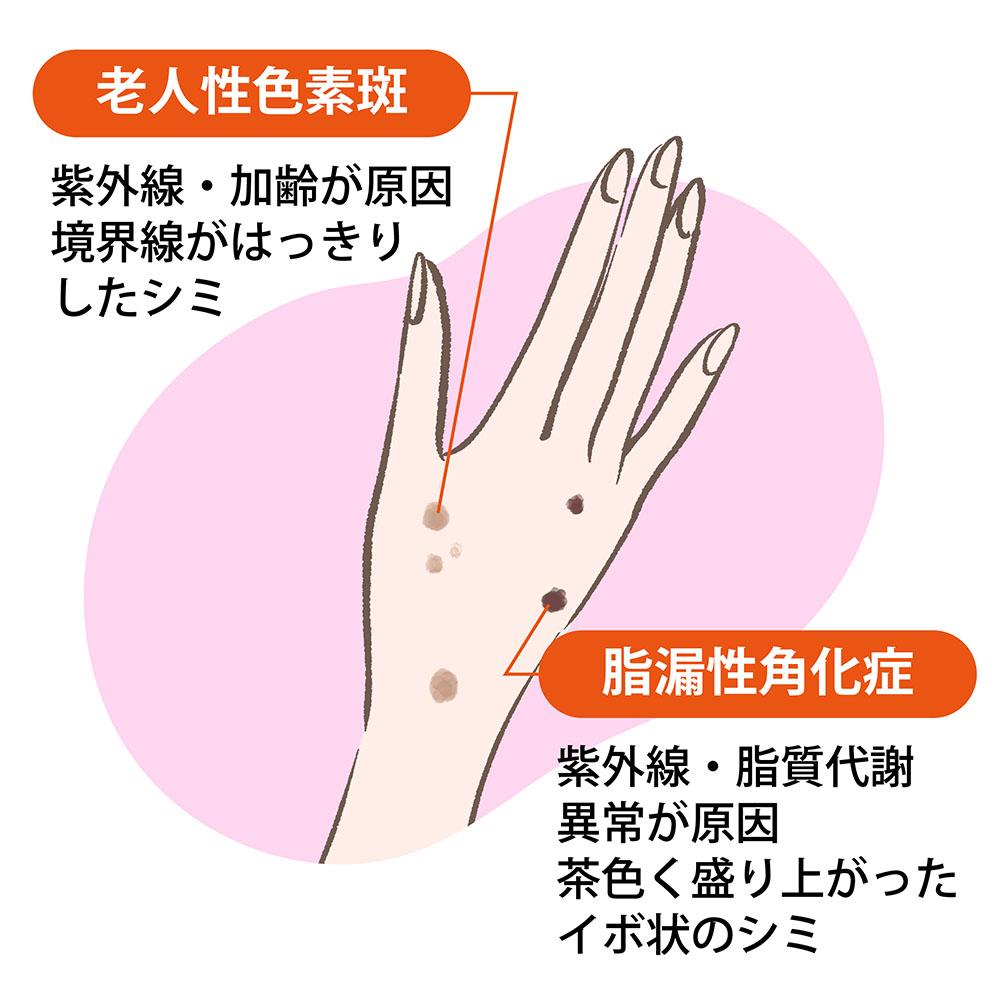手のシミの特徴と原因