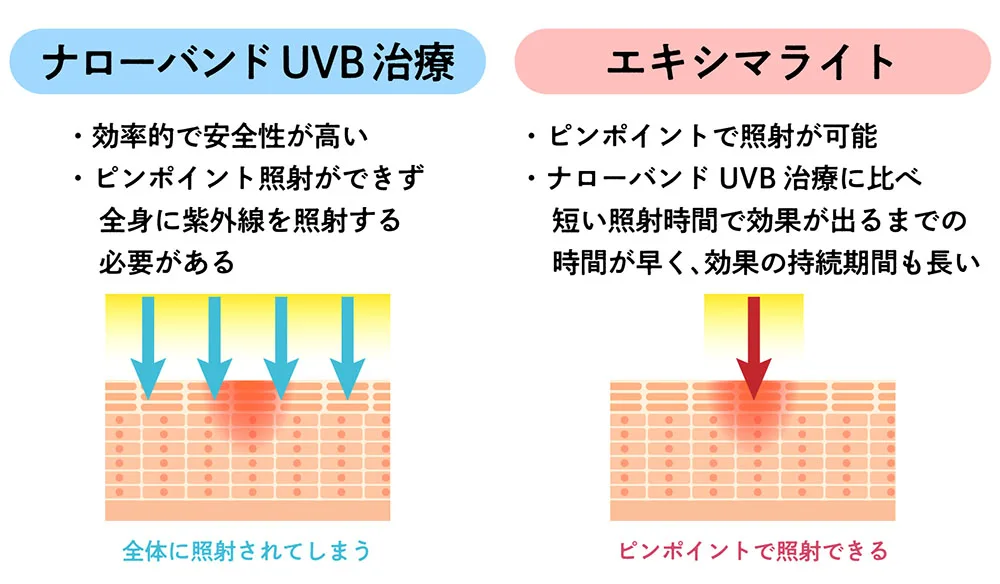 エキシマライト(光線療法)とは？適用症状、期間、料金まで徹底解説