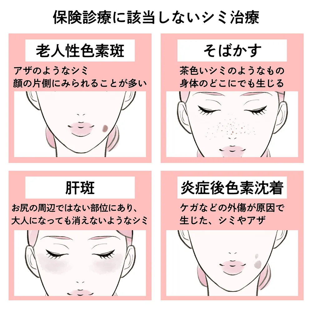 保険適用されるシミの種類は4種類。医師がシミの種類別で治療法を解説