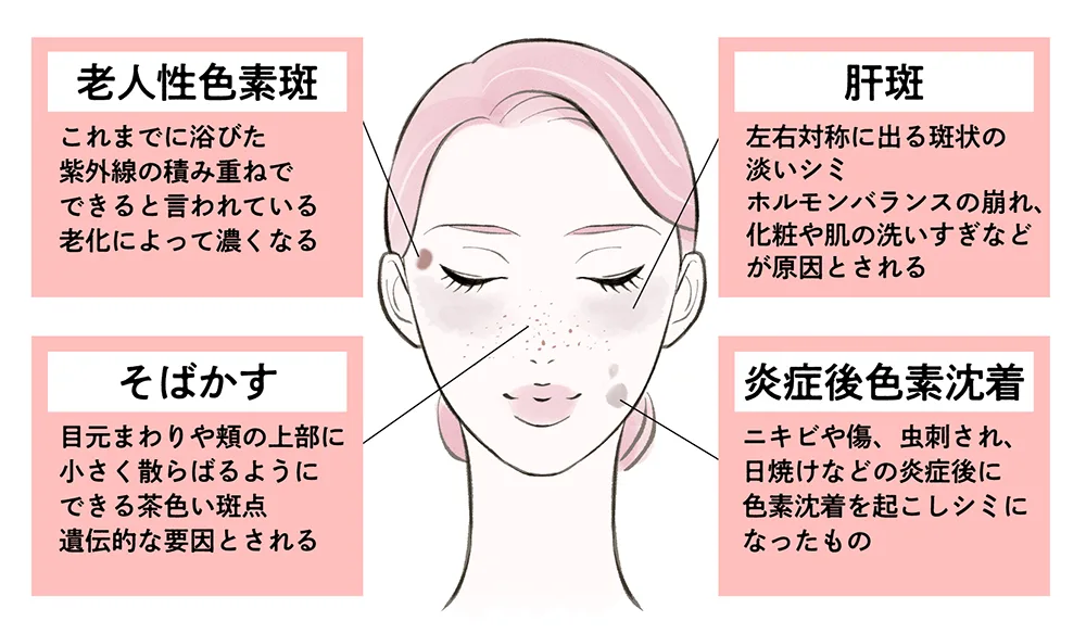 シミ取り治療おすすめ6選。シミの種類と治療を医師が徹底解説。 | 麻布