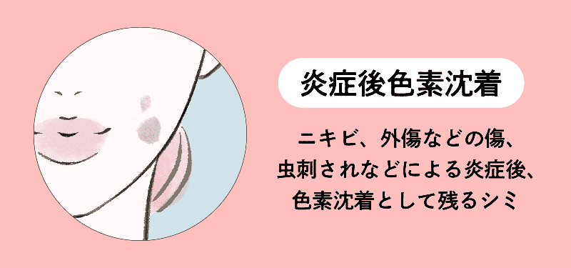 炎症後色素沈着