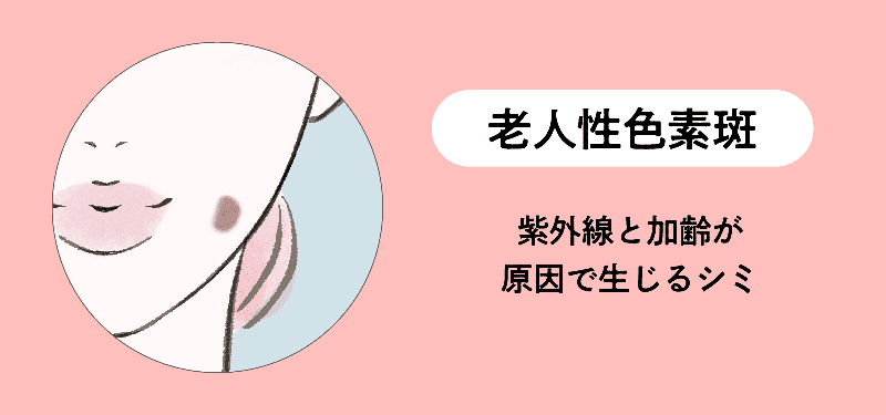 老人性色素斑