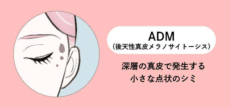 ADM（後天性真皮メラノサイトーシス）
