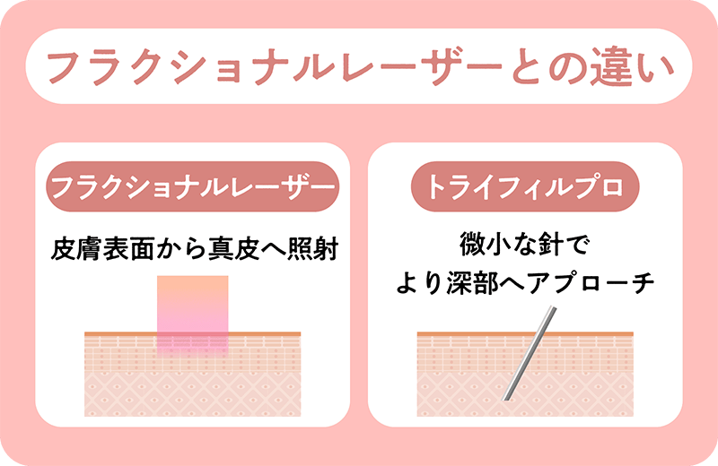 フラクショナルレーザーとの違い