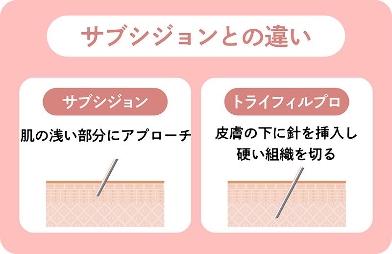 サブシジョンとの違い