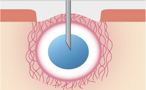 肌トラブルに合わせた薬剤を注入