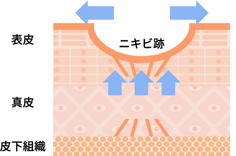 施術後、時間の経過とともに肌が平坦化